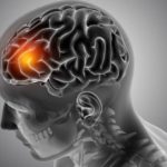Waspada 5 Jenis Disabilitas yang tersebut Sering Dialami Pasien Stroke