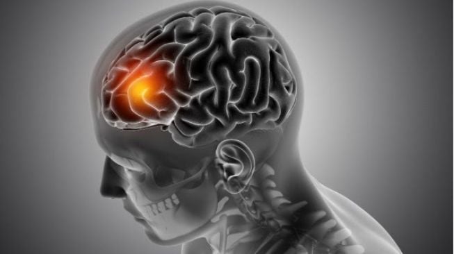 Waspada 5 Jenis Disabilitas yang tersebut Sering Dialami Pasien Stroke